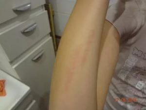 2 ярко красные полоски на руке держатся 1,5 недели! Помогите!