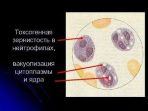 Токсогенная зернистость в крови