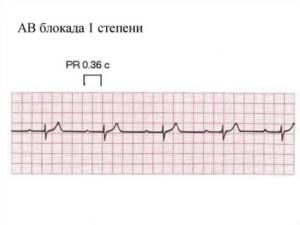 АВ блокада 1 степени