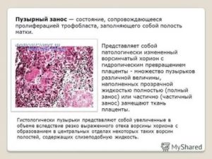 Очаговая пролиферациям трофобласта