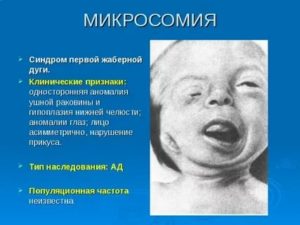 Синдром жаберных дуг и рождение хдорового ребенка