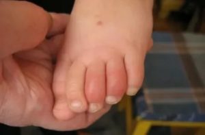 Опухший пальчик на ноге у ребенка