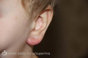Красные пятна на мочке уха у ребенка