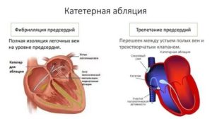 После абляции устьев лёгочных вен мучает экстрасистолия и тахикардия