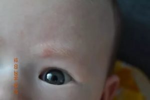 Желтоватые пятна на лбу ребенка