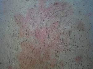 Розовые зудистые пятна на лобке