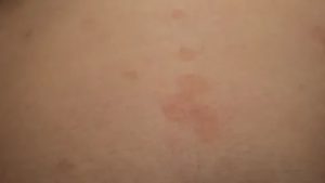 Красное Пятно на спине с болью при нажатии