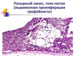 Очаговая пролиферациям трофобласта