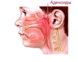Острый синусит, аденоиды 1-2 степени