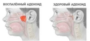 Острый синусит, аденоиды 1-2 степени