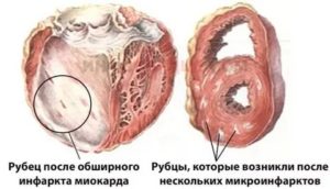 Рубец на стенке желудочка