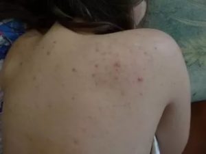 Сыпь на пояснице и боль