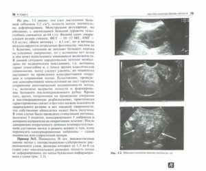 Миома с деформацией полости матки